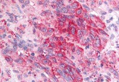 Immunohistochemistry: Prostaglandin E Synthase Antibody [NB110-39057] - Immunohistochemical analysis of lung, non small cell carcinoma.