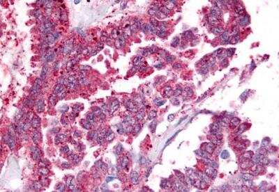 Immunohistochemistry-Paraffin: Prostaglandin E Synthase Antibody [NB110-39057] - Anti-Prostaglandin E Synthase antibody IHC of human Ovary, Carcinoma. Immunohistochemistry of formalin-fixed, paraffin-embedded tissue after heat-induced antigen retrieval.