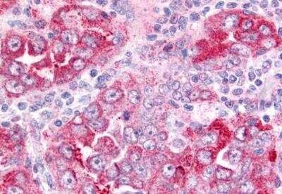Immunohistochemistry-Paraffin: Prostaglandin E Synthase Antibody [NB110-39057] - Anti-Prostaglandin E Synthase Antibody IHC of human Lung, Non-Small Cell Carcinoma. Immunohistochemistry of formalin-fixed, paraffin-embedded tissue after heat-induced antigen retrieval.