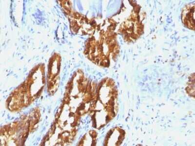 Immunohistochemistry-Paraffin: Prostatic Acid Phosphatase/ACPP Antibody (ACPP/1338) [NBP2-54308] - Formalin-fixed, paraffin-embedded human Prostate Carcinoma stained with PSAP Monoclonal Antibody (ACPP/1338).