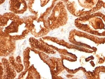 Immunohistochemistry-Paraffin: Prostatic Acid Phosphatase/ACPP Antibody (SPM312) [NBP2-54475] - Formalin-fixed, paraffin-embedded human Prostate Carcinoma stained with PSAP Monoclonal Antibody (SPM312).