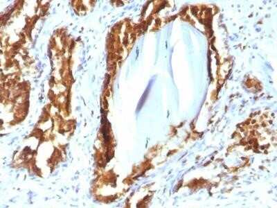 Immunohistochemistry-Paraffin: Prostatic Acid Phosphatase/ACPP Antibody (rACPP/1338) - Azide and BSA Free [NBP2-75777] - Formalin-fixed, paraffin-embedded human Prostate Carcinoma stained with PSAP Mouse Recombinant Monoclonal Antibody (rACPP/1338).