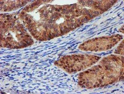 Immunohistochemistry-Paraffin: Proteasome 19S 10B Antibody (1G6) [NBP2-00990] - Staining of paraffin-embedded Adenocarcinoma of Human endometrium tissue using anti-Proteasome 19S 10B mouse monoclonal antibody.