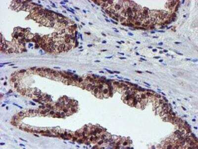 Immunohistochemistry-Paraffin: Proteasome 19S 10B Antibody (1G6) [NBP2-00990] - Staining of paraffin-embedded Carcinoma of Human prostate tissue using anti-Proteasome 19S 10B mouse monoclonal antibody.