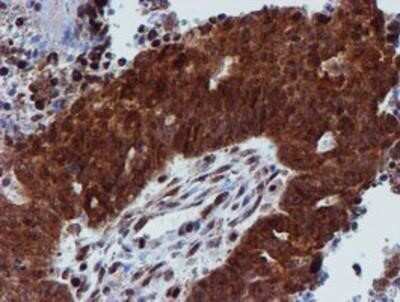 Immunohistochemistry: Proteasome 19S 10B Antibody (OTI1G6) - Azide and BSA Free [NBP2-73627] - Staining of paraffin-embedded Adenocarcinoma of Human ovary tissue using anti-Proteasome 19S 10B mouse monoclonal antibody.
