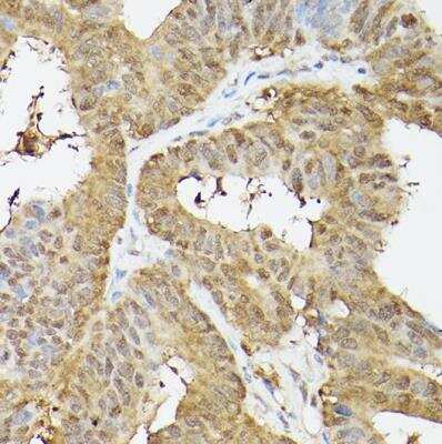 Immunohistochemistry-Paraffin: Proteasome 20S alpha 3 Antibody [NBP2-94032] - Human colon carcinoma using PSMA3 Rabbit pAb at dilution of 1:100 (40x lens).