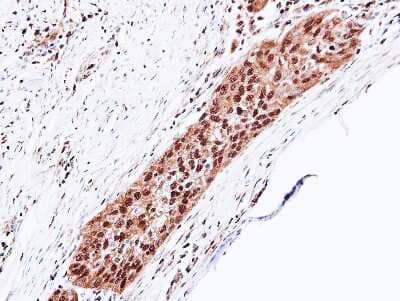 Immunohistochemistry-Paraffin: Proteasome 20S alpha 5 Antibody [NBP1-32387] - Paraffin-embedded H1299 xenograft, using antibody at 1:100 dilution.