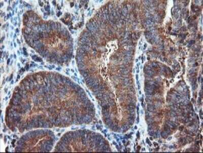 Immunohistochemistry: Proteasome 20S alpha 6 Antibody (OTI3B8) - Azide and BSA Free [NBP2-73642] - Analysis of Adenocarcinoma of Human endometrium tissue.