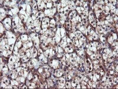 Immunohistochemistry: Proteasome 20S alpha 6 Antibody (OTI3B8) - Azide and BSA Free [NBP2-73642] - Analysis of Carcinoma of Human kidney tissue.