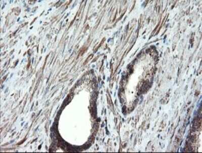 Immunohistochemistry: Proteasome 20S alpha 6 Antibody (OTI3B8) - Azide and BSA Free [NBP2-73642] - Analysis of Carcinoma of Human prostate tissue.