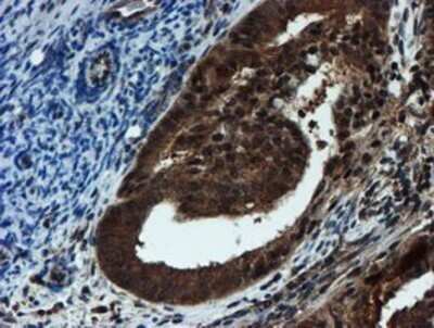 Immunohistochemistry: Proteasome 20S alpha 6 Antibody (OTI4C9) - Azide and BSA Free [NBP2-73637] - Staining of paraffin-embedded Adenocarcinoma of Human endometrium tissue using anti-Proteasome 20S alpha 6 mouse monoclonal antibody.