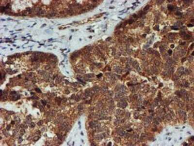 Immunohistochemistry: Proteasome 20S alpha 6 Antibody (OTI4C9) - Azide and BSA Free [NBP2-73637] - Staining of paraffin-embedded Adenocarcinoma of Human ovary tissue using anti-Proteasome 20S alpha 6 mouse monoclonal antibody.