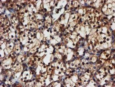 Immunohistochemistry: Proteasome 20S alpha 6 Antibody (OTI4C9) - Azide and BSA Free [NBP2-73637] - Staining of paraffin-embedded Carcinoma of Human kidney tissue using anti-Proteasome 20S alpha 6 mouse monoclonal antibody.