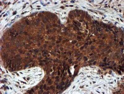 Immunohistochemistry: Proteasome 20S alpha 6 Antibody (OTI4C9) - Azide and BSA Free [NBP2-73637] - Staining of paraffin-embedded Carcinoma of Human lung tissue using anti-Proteasome 20S alpha 6 mouse monoclonal antibody.