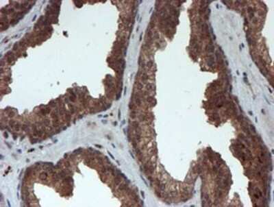 Immunohistochemistry: Proteasome 20S alpha 6 Antibody (OTI4C9) - Azide and BSA Free [NBP2-73637] - Staining of paraffin-embedded Carcinoma of Human prostate tissue using anti-Proteasome 20S alpha 6 mouse monoclonal antibody.