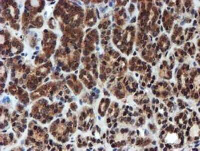 Immunohistochemistry: Proteasome 20S alpha 6 Antibody (OTI4C9) - Azide and BSA Free [NBP2-73637] - Staining of paraffin-embedded Carcinoma of Human thyroid tissue using anti-Proteasome 20S alpha 6 mouse monoclonal antibody.