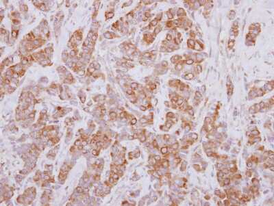Immunohistochemistry-Paraffin: Proteasome 26S S5 Antibody [NBP2-19956] - Human breast cancer, using PSMD5  antibody at 1:250 dilution.  Antigen Retrieval: Trilogy™ (EDTA based, pH 8.0) buffer, 15min