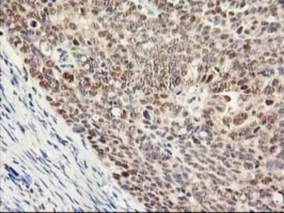 Immunohistochemistry-Paraffin: Proteasome subunit beta type 4 Antibody (2C9) [NBP2-01225] - Staining of paraffin-embedded Adenocarcinoma of Human ovary tissue using anti-Proteasome subunit beta type 4 mouse monoclonal antibody.