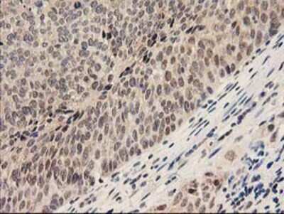 Immunohistochemistry-Paraffin: Proteasome subunit beta type 4 Antibody (2C9) [NBP2-01225] - Staining of paraffin-embedded Carcinoma of Human bladder tissue using anti-Proteasome subunit beta type 4 mouse monoclonal antibody.