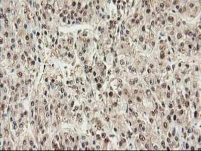 Immunohistochemistry-Paraffin: Proteasome subunit beta type 4 Antibody (2C9) [NBP2-01225] - Staining of paraffin-embedded Carcinoma of Human liver tissue using anti-Proteasome subunit beta type 4 mouse monoclonal antibody.