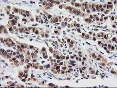 Immunohistochemistry-Paraffin: Proteasome subunit beta type 4 Antibody (2C9) [NBP2-01225] - Staining of paraffin-embedded Carcinoma of Human lung tissue using anti-Proteasome subunit beta type 4 mouse monoclonal antibody.