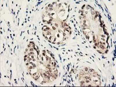 Immunohistochemistry: Proteasome subunit beta type 4 Antibody (OTI2C9) - Azide and BSA Free [NBP2-73655] - Staining of paraffin-embedded Adenocarcinoma of Human breast tissue using anti-Proteasome subunit beta type 4 mouse monoclonal antibody.
