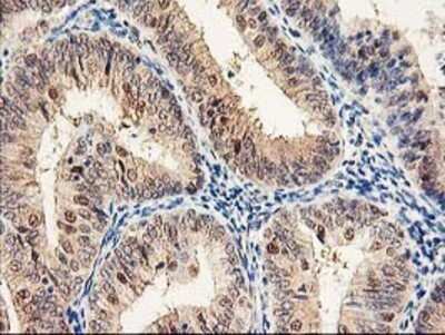 Immunohistochemistry: Proteasome subunit beta type 4 Antibody (OTI2C9) - Azide and BSA Free [NBP2-73655] - Staining of paraffin-embedded Adenocarcinoma of Human endometrium tissue using anti-Proteasome subunit beta type 4 mouse monoclonal antibody.