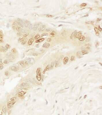 Immunohistochemistry: Pygopus-1 Antibody [NBP1-42665] - Sample: FFPE section of human colon carcinoma. Antibody: Affinity purified rabbit anti- Pygo1 used at a dilution of 1:1,000 (1ug/ml). Detection: DAB