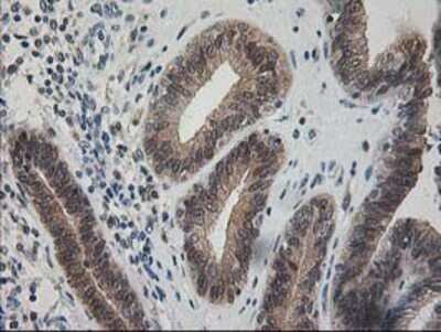 Immunohistochemistry: Pyridoxal Kinase/PDXK Antibody (OTI5H5) - Azide and BSA Free [NBP2-73754] - Staining of paraffin-embedded Adenocarcinoma of Human endometrium tissue using anti-PDXK mouse monoclonal antibody.