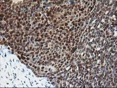 Immunohistochemistry: Pyridoxal Kinase/PDXK Antibody (OTI5H5) - Azide and BSA Free [NBP2-73754] - Staining of paraffin-embedded Adenocarcinoma of Human ovary tissue using anti-PDXK mouse monoclonal antibody.