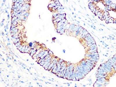 Immunohistochemistry-Paraffin: Pyruvate Dehydrogenase E1 beta subunit Antibody (7V8O5) [NBP3-16455] - Immunohistochemistry of paraffin-embedded human colon carcinoma using Pyruvate Dehydrogenase E1 beta subunit Rabbit mAb (NBP3-16455) at dilution of 1:100 (40x lens).Perform microwave antigen retrieval with 10 mM PBS buffer pH 7.2 before commencing with IHC staining protocol.