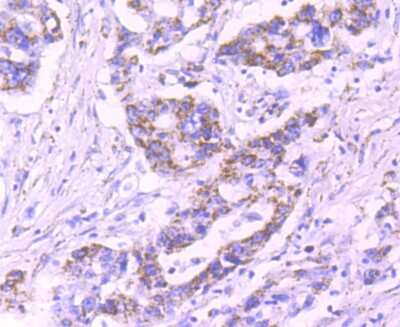 Immunohistochemistry-Paraffin: Pyruvate Dehydrogenase E1 beta subunit Antibody (JM66-33) [NBP2-75639] - Analysis of paraffin-embedded human stomach cancer tissue using anti-Pyruvate Dehydrogenase E1 beta subunit antibody. Counter stained with hematoxylin.