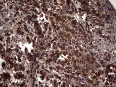 Immunohistochemistry: R-Spondin 3 Antibody (OTI3D5) - Azide and BSA Free [NBP2-73949] - Analysis of Adenocarcinoma of Human breast tissue. (Heat-induced epitope retrieval by 1 mM EDTA in 10mM Tris, pH8.5, 120C for 3min)