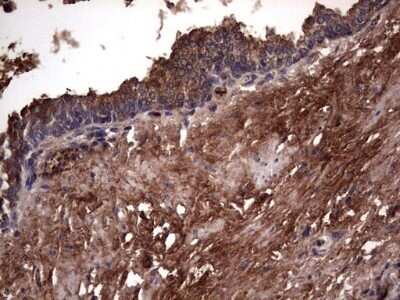 Immunohistochemistry: R-Spondin 3 Antibody (OTI3D5) - Azide and BSA Free [NBP2-73949] - Analysis of Carcinoma of Human prostate tissue. (Heat-induced epitope retrieval by 1 mM EDTA in 10mM Tris, pH8.5, 120C for 3min)
