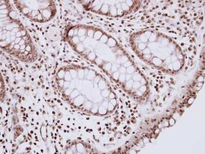 Immunohistochemistry-Paraffin: R3HDM2 Antibody [NBP2-20032] - Immunohistochemical analysis of paraffin-embedded Colon ca, using antibody at 1:250 dilution.