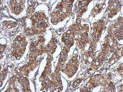 Immunohistochemistry-Paraffin: RAB11FIP5 Antibody [NBP2-20035] - Analysis of paraffin-embedded Hepatoma, using antibody at 1:500 dilution.