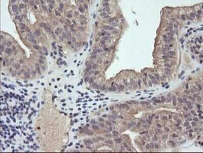 Immunohistochemistry: RAB21 Antibody (OTI6E12) - Azide and BSA Free [NBP2-73769] - Analysis of Adenocarcinoma of Human ovary tissue. (Heat-induced epitope retrieval by 10mM citric buffer, pH6.0, 120C for 3min)