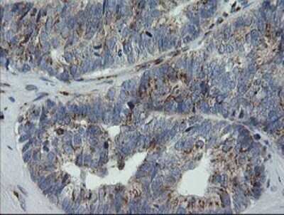 Immunohistochemistry: RAB30 Antibody (OTI3E7) - Azide and BSA Free [NBP2-73771] - Analysis of Adenocarcinoma of Human ovary tissue. (Heat-induced epitope retrieval by 10mM citric buffer, pH6.0, 120C for 3min)