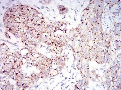 Immunohistochemistry: RAB6B Antibody (6D12G9) [NBP2-61824] - Analysis of paraffin-embedded bladder cancer tissues using Rab6b mouse mAb with DAB staining.