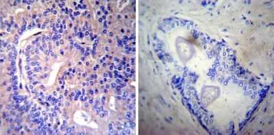 Immunohistochemistry-Paraffin: RAB9A Antibody (Mab9) [NB300-621] - Both normal and cancer biopsies of deparaffinized Human prostate carcinoma tissues.