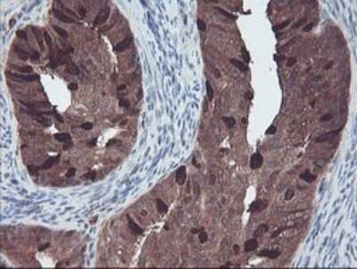 Immunohistochemistry: RABL2A Antibody (OTI4A3) - Azide and BSA Free [NBP2-73777] - Analysis of Adenocarcinoma of Human endometrium tissue.