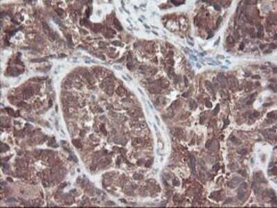 Immunohistochemistry: RABL2A Antibody (OTI4A3) - Azide and BSA Free [NBP2-73777] - Analysis of Adenocarcinoma of Human ovary tissue.