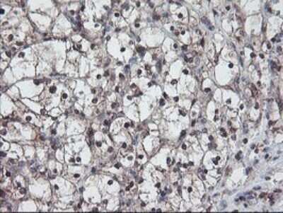 Immunohistochemistry: RABL2A Antibody (OTI4A3) - Azide and BSA Free [NBP2-73777] - Analysis of Carcinoma of Human kidney tissue.