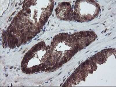 Immunohistochemistry: RABL2A Antibody (OTI4A3) - Azide and BSA Free [NBP2-73777] - Analysis of Carcinoma of Human prostate tissue.
