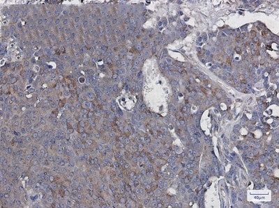 Immunohistochemistry-Paraffin: RAC3 Antibody (S01-6I8) [NBP3-19756] - Immunohistochemistry of RAC3 in paraffin-embedded Human breast cancer tissue using NBP3-19756 at dilution 1/20