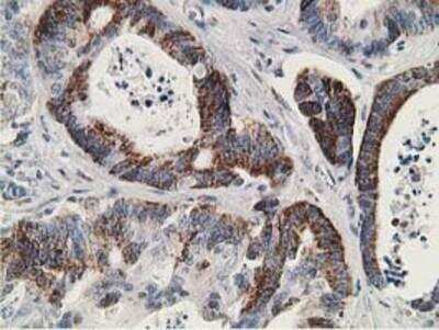 Immunohistochemistry-Paraffin: RACK1/GNB2L1 Antibody (2D8) [NBP2-00612] - Staining of paraffin-embedded Adenocarcinoma of Human colon tissue using anti-GNB2L1 mouse monoclonal antibody.