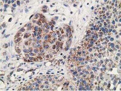 Immunohistochemistry-Paraffin: RACK1/GNB2L1 Antibody (2D8) [NBP2-00612] - Staining of paraffin-embedded Carcinoma of Human bladder tissue using anti-GNB2L1 mouse monoclonal antibody.