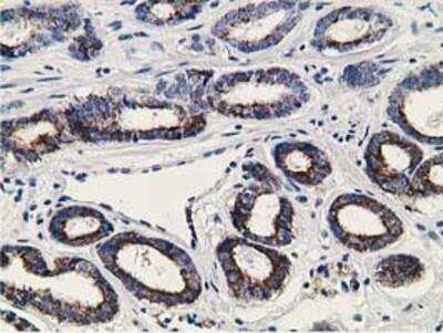 Immunohistochemistry-Paraffin: RACK1/GNB2L1 Antibody (2D8) [NBP2-00612] -  Staining of paraffin-embedded Carcinoma of Human prostate tissue using anti-GNB2L1 mouse monoclonal antibody.