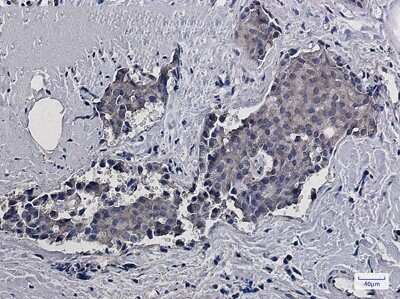 Immunohistochemistry-Paraffin: RACK1/GNB2L1 Antibody (S02-1K6) [NBP3-14967] - Immunohistochemistry of RACK1/GNB2L1 in paraffin-embedded Human breast cancer tissue using RACK1/GNB2L1 Rabbit mAb at dilution 1/20