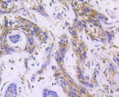 Immunohistochemistry-Paraffin: RALBP1 Antibody (SC06-49) [NBP2-67633] - Analysis of paraffin-embedded human breast carcinoma tissue using anti-RALBP1 antibody. Counter stained with hematoxylin.